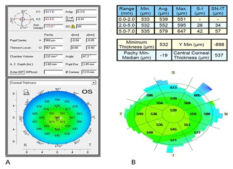 central corneal thickness measurement|corneal pachymetry iop chart.